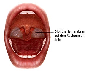 diphtherie-membran